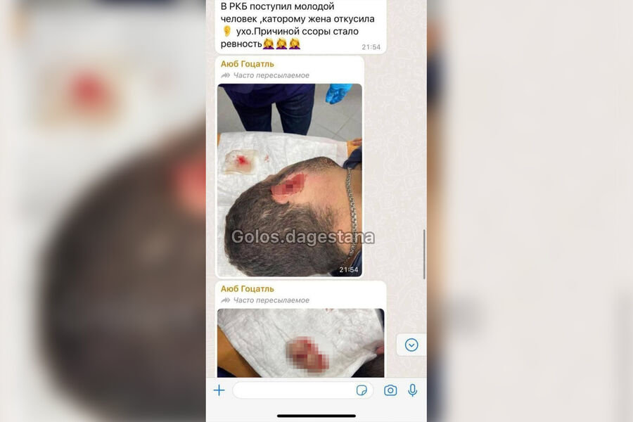 В Дагестане жена во время ссоры откусила мужу ухо